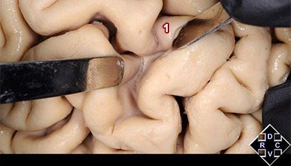 12: Vista lateral de un hemisferio cerebral izquierdo en el que se abre el surco precentral