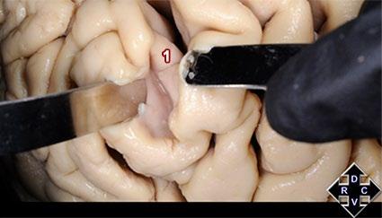 16: Vista medial de un hemisferio cerebral izquierdo en el que se abre el surco