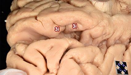17: Vista posteromedial de un hemisferio cerebral izq.