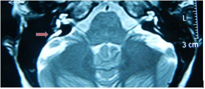 Síndrome de acueducto vestibular dilatado: a propósito de un caso Figura 5.