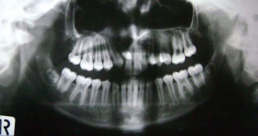 FIGURA N 2 Radiografía panorámica perteneciente a un paciente con fisura labio alveolo palatina unilateral derecha donde se observa una