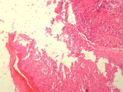A mayor aumento en la zona de la úlcera, se observa, una superficie necrótica con una pseudomembrana en la que se distinguen colonias