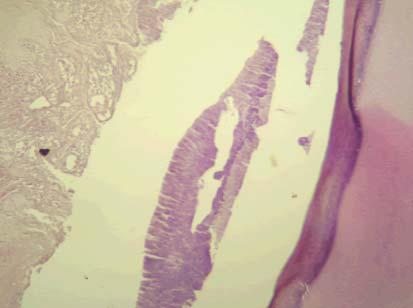 La pared gingival muestra cambios hiperplásicos en el epitelio plano estratificado no queratinizado, con acantosis, papilomatosis y edema intercelular (espongiosis).