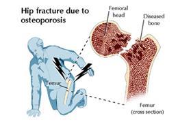 Figura: Fractura de cadera posterior a una caída en adulto mayor con osteoporosis Cuál es la importancia de las caídas en el adulto mayor?