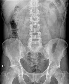 PARTE 2 1. La imagen de la izquierda corresponde a una radiografía: a) Simple de abdomen AP.