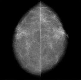 La imagen de la izquierda corresponde a un estudio de: a) Mamografía bilateral en proyección