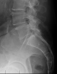 2. La imagen de la izquierda corresponde a: a) Radiografía lateral de columna lumbar.