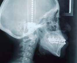 asimetría facial severa A B Figura 5. A. Radiografía posteroanterior pre-quirúrgica, y B.