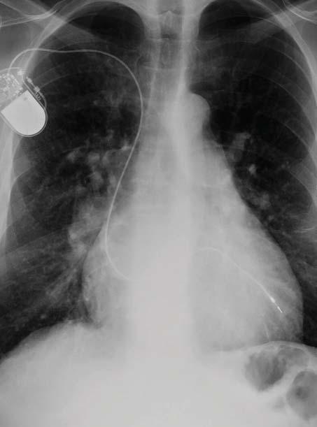 Figura 2. Radiografías de tórax posteroanterior y lateral. Cardiomegalia moderada, cono de la arteria pulmonar prominente, plétora pulmonar y cable de marcapasos en el VI.