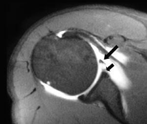 Como la cabeza larga bicipital se inserta en esta zona es común que una lesión de SLAP produzca la desinserción de dicho tendón 1,4.
