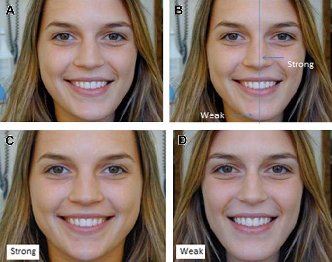 Paciente con asimetría facial media (modelo).