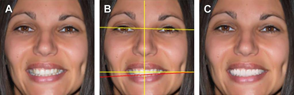 A- Paciente con el ojo y ceja izquierdos levemente más bajos. B-La línea media facial es levemente asimétrica. La línea interpupilar se inclina haia abajo y a la izquierda.
