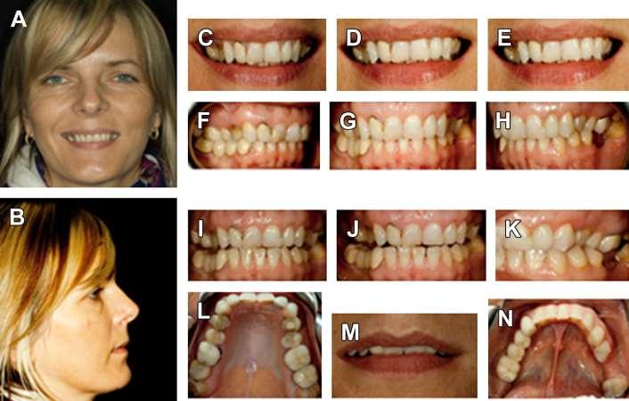 SET DE FOTOGRAFÍAS NECESARIO (A) Full-face frontal view. (B) Profile view. (C) Right smile. (D) Centered smile. (E) Left smile. (F) Right retracted biting.