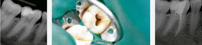 Andreas Braun, Marburg (GER) Reducción de gérmenes en la endodoncia Los rayos láser penetran mucho más profundamente en los túbulos dentinarios en comparación con las soluciones de irrigación