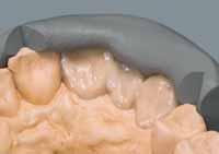 Nota: Un modelo anatómicamente parecido sirve de plantilla y ayuda a transferir las características de cada forma de diente a la confección del encerado.