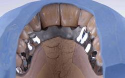 Preparación Control de los dientes Creopal colocados Antes de acondicionar los dientes Creopal y las shells Creopal se debe comprobar la posición de