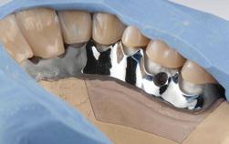 Esto garantiza una transición armónica de los dientes a la estructura terciaria.