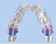 El distalizador va pegado directamente a la superficie bucal del primer molar y al canino maxilar o al primer premolar.
