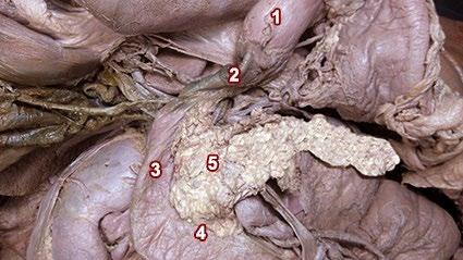 3: Se observa un ganglio celiaco izquierdo con morfología variante columnar Fig.