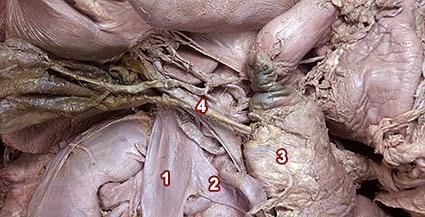 1: Vena cava inferior 2: vena renal izquierda 3: cara posterior de la cabeza del páncreas 4: