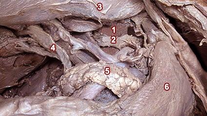 Fig.7: Visión anterior de región supramesocólica. 1: pilar diafragmático derecho 2: ganglio celiaco derecho 3: hígado 4: pedículo hepático 5: páncreas 6: estomago. Fig.