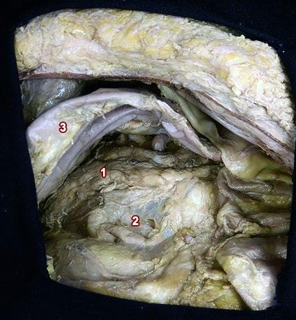 Fig. 16: Abordaje anterior del ganglio celiaco izquierdo. Plano fascia-muscular. Fig. 17: Abordaje anterior del ganglio celiaco izquierdo. Plano profundo.