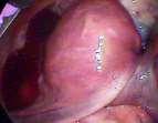izquierdo de 38 mm x 48 mm, tumor de ovario derecho de 96 mm x 70 mm, lobulado, densidad heterogénea y calcificaciones Colecistitis