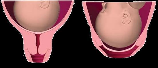 Cambios en el cuello uterino Borramiento: adelgazamiento y