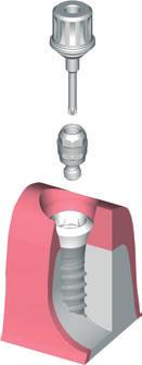 C) Colocación del trabajo definitivo La entrega al odontólogo se realiza con el pilar original en el modelo.