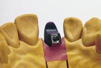 Para controlar la configuración de la estructura se emplea la llave de silicona del encerado de diagnóstico. El modelado se realiza con forma dental reducida.