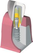 C) Ajuste de la restauración terminada La restauración se entrega al odontólogo con el pilar a medida colocado en el modelo maestro.