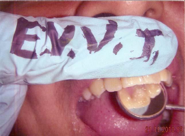 FOTO #6 Presentación del caso terminado Pieza dental tallada pulida y abrillantada