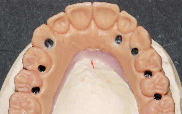 Se decidió por una restauración de implantes semifijos en los maxilares superior e inferior.