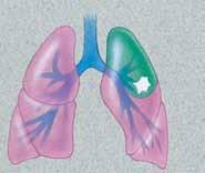 La neumonectomía es la extirpación de todo un pulmón.