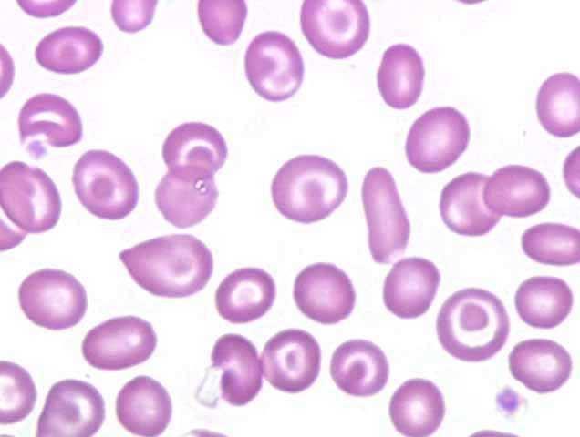 Pregunta 11 O El rasgo falciforme es una condición que consiste en la.usualmente, los portadores son asintomáticos y no presentan anemia. 1. Presencia de hemoglobina A y F, en general, en la proporción de 60:40; 2.