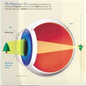 hipermetropía es el defecto refractivo con mayor frecuencia en estos niños.
