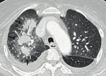 Figura 2 Tomografía de tórax. Corte axial. Ventana de pulmón.