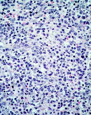 Linfoma Anaplásico de células grandes, ALK negativo Fuerte expresión de CD30 Fenotipo citotóxico