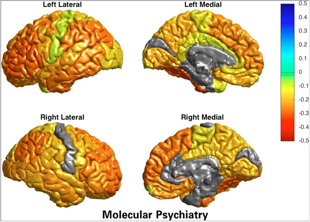 81 Figura 1: Adelgazamiento cortical en pacientes adultos con trastorno bipolar en comparación con controles sanos.