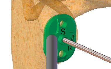 osteofitos para exponer adecuadamente la anatomía del hueso 2 Colocación de la aguja: (desgaste simétrico) Coloque la