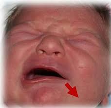ETIOLOGIA La parálisis facial periférica, suele ser desconocida o idiopática en la mayoría de los casos (parálisis de Bell).