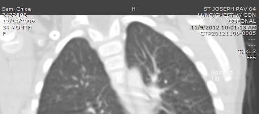 Diagnostico y Tratamiento Biopsia de pulmon