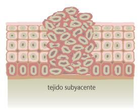 EL INICIO DEL CRECIMIENTO DE LAS CÉLULAS DEL CÁNCER El balance normal entre la división celular y la pérdida de las células se descontrola durante el desarrollo de cáncer de la piel.