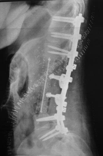 Figuras 15: a: Imagen radiográfica de la pieza tumoral, en sagital y en coronal.