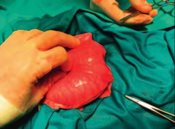con un control hemostático como NUNCA CIRUGÍA ABDOMINAL En cirugía abdominal, la incisión de la pared del