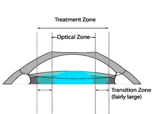 MATERIALES Y MÉTODOS Protocolo clínico Tratamiento Wavefront Optimized Zona de tratamiento zona óptica Tratamiento No optimizado Zona de tratamiento zona óptica zona de transición zona de transición