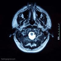 Edema cerebral INDICACIONES - Evaluación diagnóstica de oliguria aguda. - Prevención de fallo renal agudo.