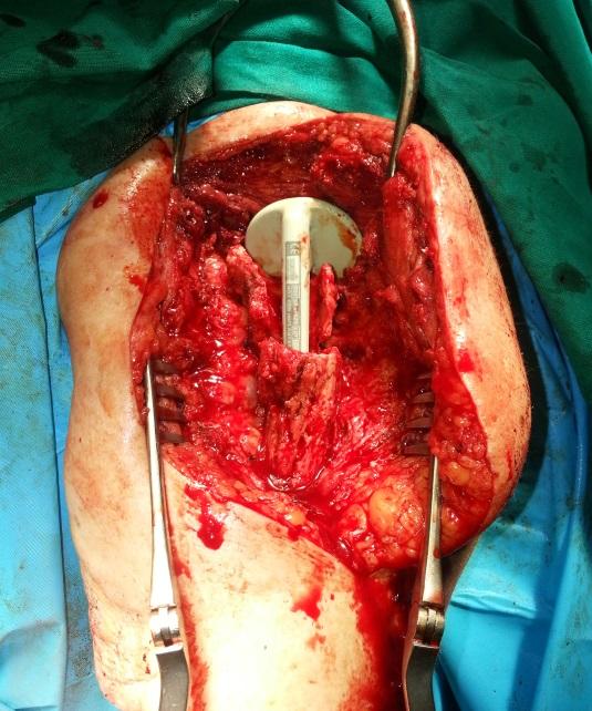 Extracción de la prótesis en bloque.