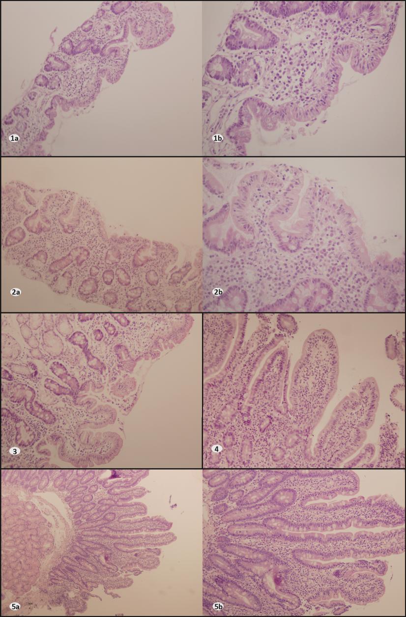 Resultados En la Figura 16 se muestran las biopsias de 5 de los 6 pacientes celíacos (pediátricos y adultos) con HLA-DQ7.