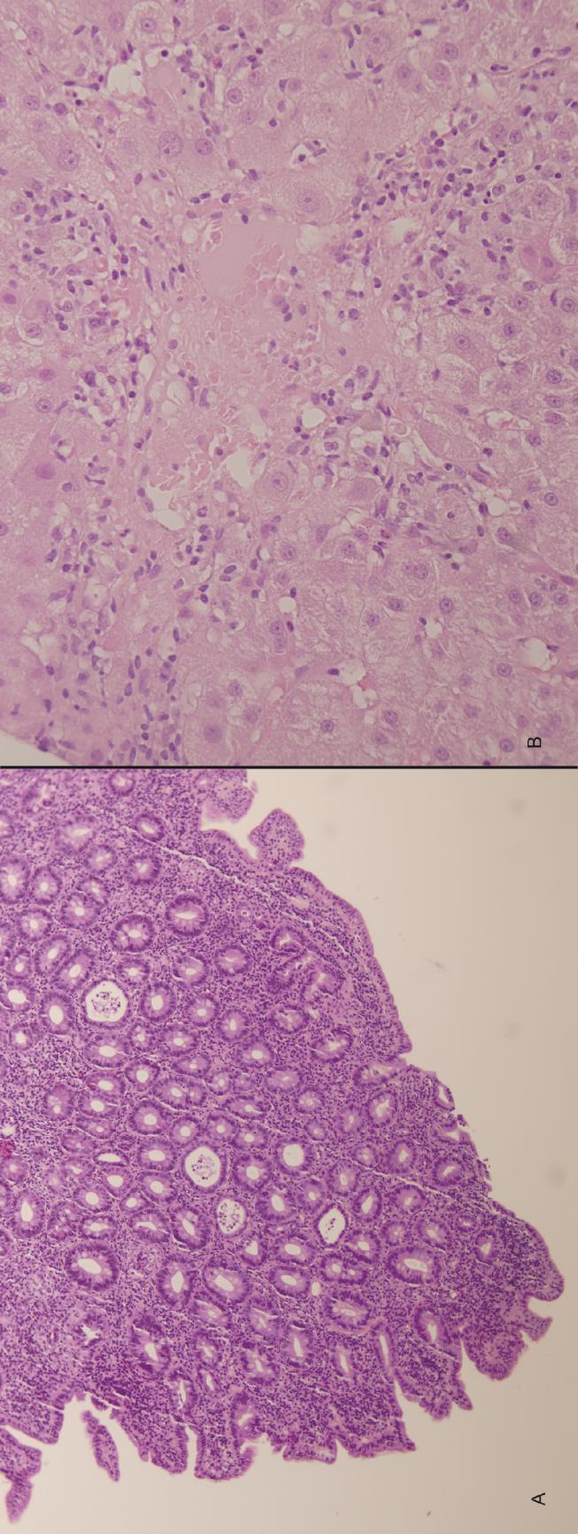 Figura 17. Imágenes histológicas de biopsias de duodeno e hígado del caso nº3.